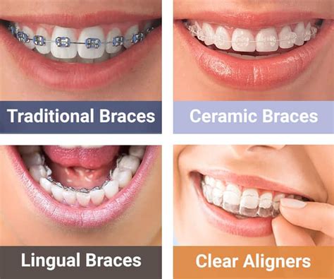 what are the cheapest type of braces